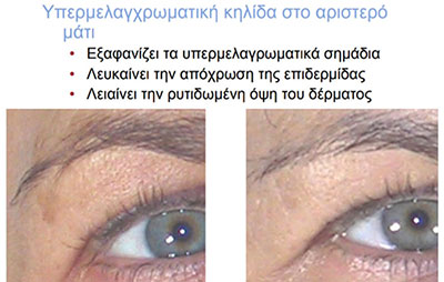 ΜΙΚΡΟΔΕΡΜΟΑΠΟΞΕΣΗ